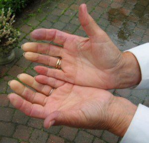 Синдром на Рейно засяга ръцете и пръстите