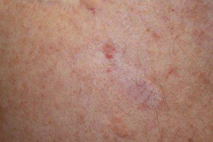 базално клетъчен карцином рак на кожата