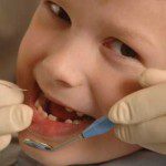 кариес при децата млечни зъби
