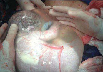 Зрелищно раждане - извадиха бебе с околоплодните води