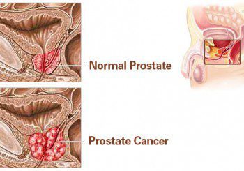 Безплатни профилактични прегледи за рак на простатата в Софиямед