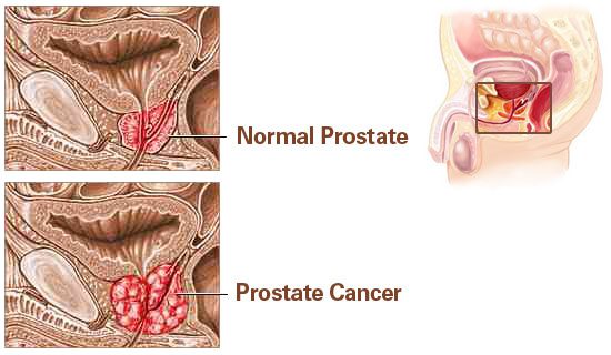 рак на простатата