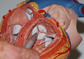 Съвременни методики за имплантиране на аортна клапа