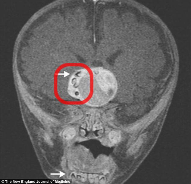 Снимка на тумора с магнитен резонанс