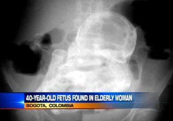 Вкаменено бебе откриха в утробата на 84-годишна старица