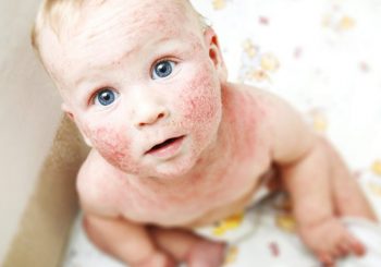 Как да лекувам кожата по лицето на детето, непрекъснато се напуква?