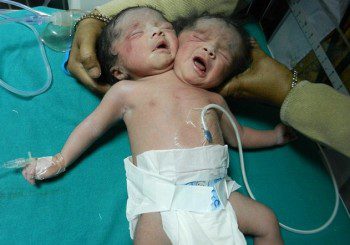 Роди се бебе с две глави в Индия