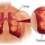лечението на рака на белия дроб е трудно.