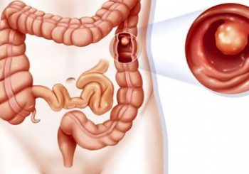 Полипите на дебелото черво - симптоми, диагноза и лечение