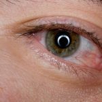 сухо око възпаление на окото