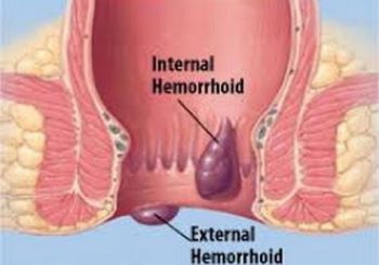 Лечение на хемороиди според тежестта на симптомите
