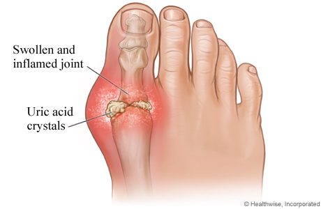 gout diet nutrition purines