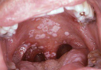 Как да се спасим от соор - гъбична инфекция в устата