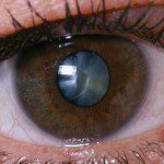 катаракта перде на окото операция