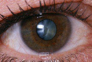 катаракта перде на окото операция