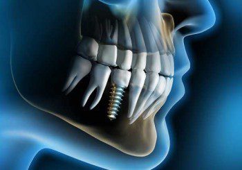 зъбен имплант