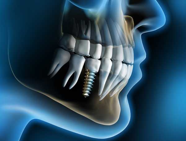 зъбен имплант