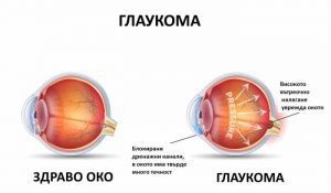 глаукома причини