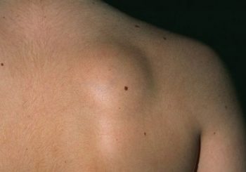 Кога се оперира липом - мастна бучка под кожата?