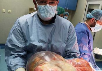 Гигантски тумор извадиха от корема на жена във ВМА