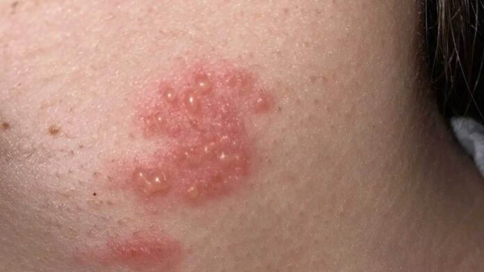 herpes zoster rash and treatment